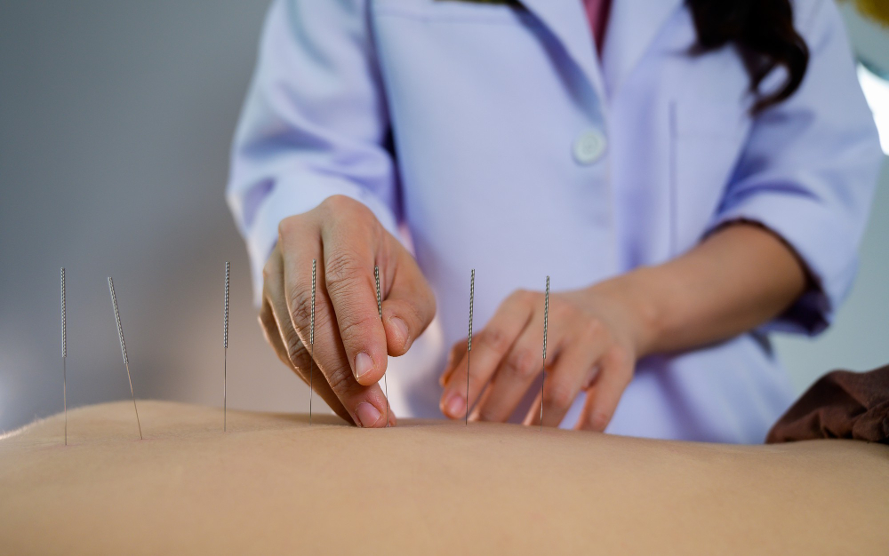 Acupuncture Therapy Dublin